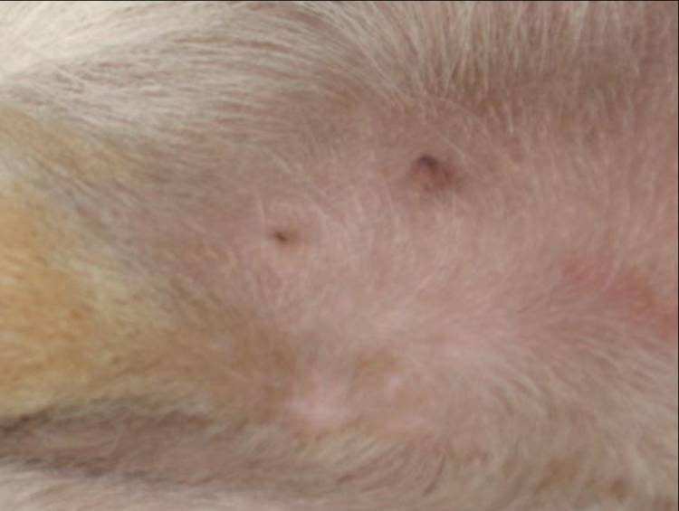 pimple2