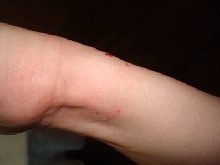 Black Head Python Bite Aftermath