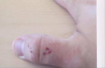 garter bite