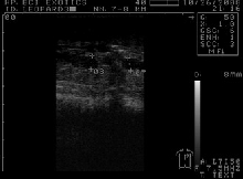 Ultrasound image of follicles
