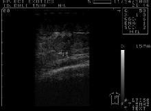 Ultrasound image of follicles