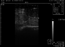 Ultrasound image of follicles