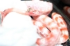The swollen umbilical