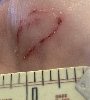gecko bite
