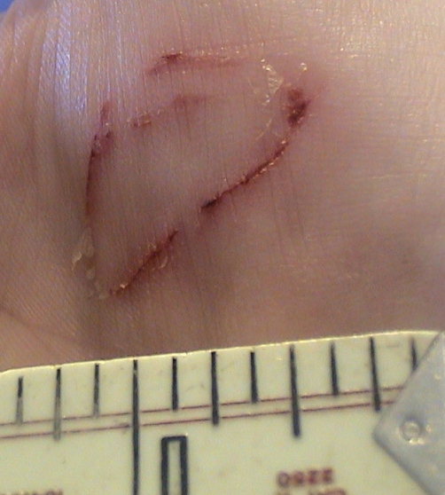 gecko bite