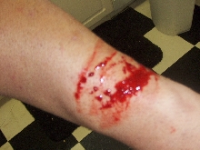 bite wound