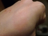 Allergic reaction