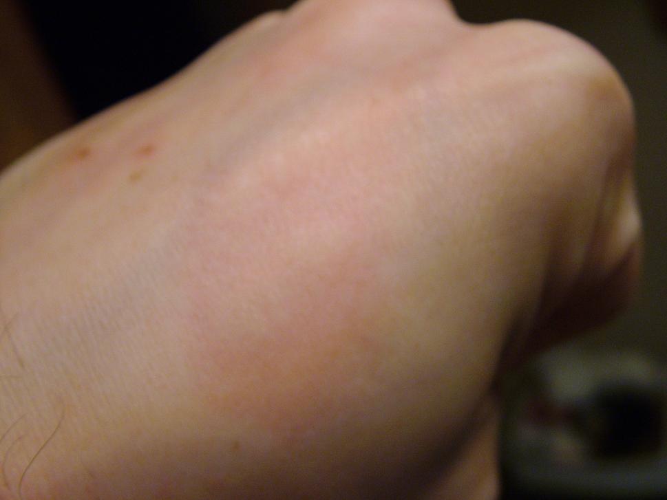 Allergic reaction