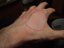 Allergic reaction