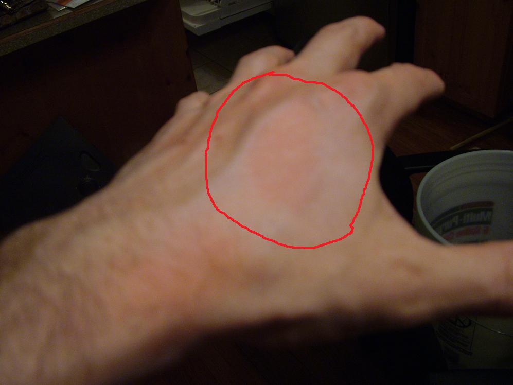 Allergic reaction
