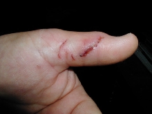 Bite1