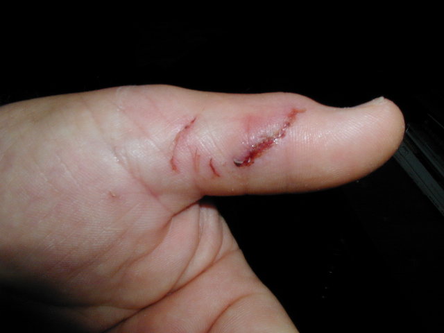 Bite1