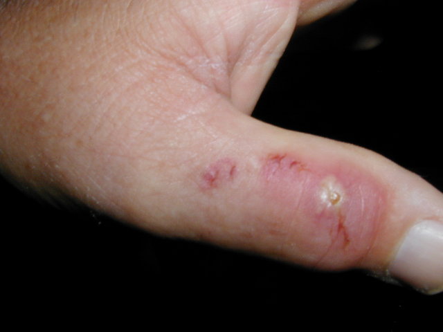 bite2