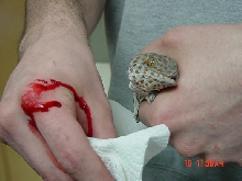 Tokay gecko bite