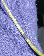 Tail trauma1