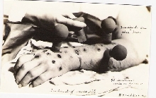 "Treatment of snakebite" postcard