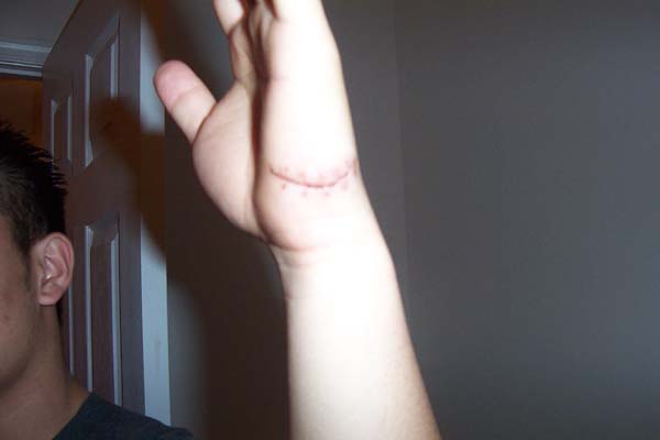 stitches Removed
