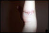after stitches2