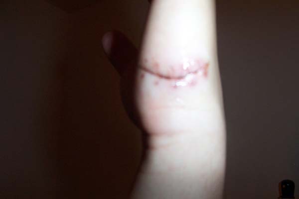 after stitches2