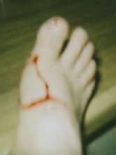 Angel bite 06-13-04