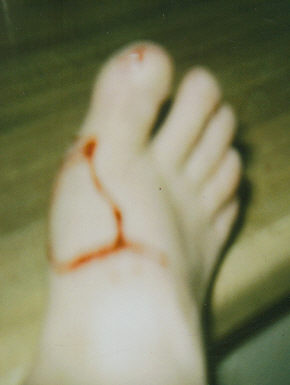 Angel bite 06-13-04