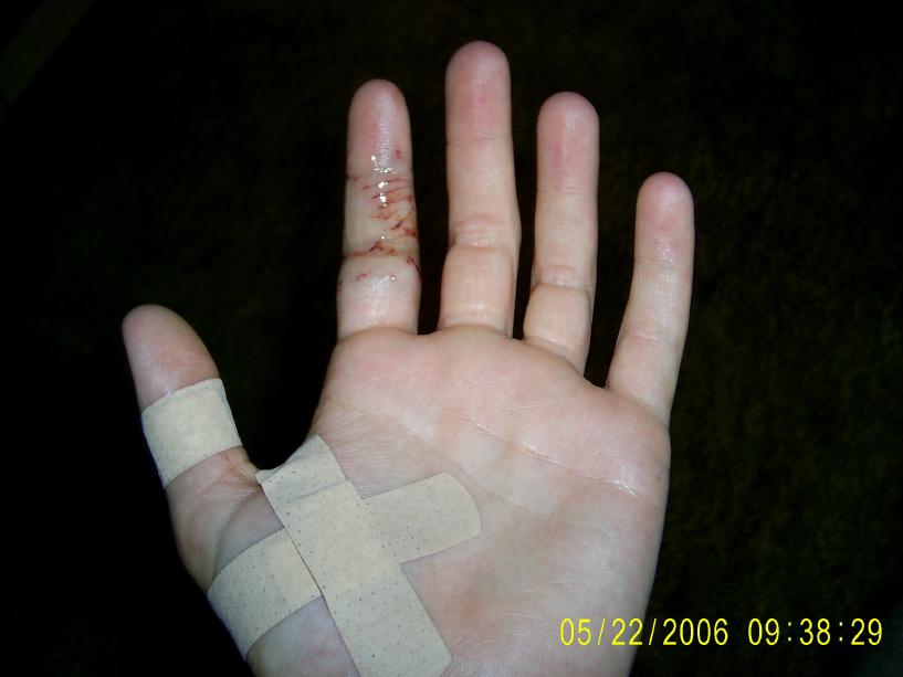 Results of a bite from a 13' barneck