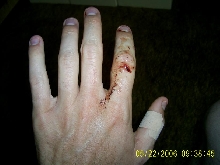 Results of a bite from a 13' barneck