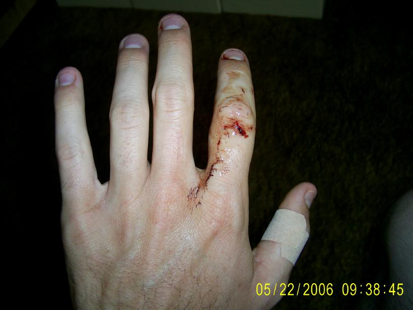 Results of a bite from a 13' barneck