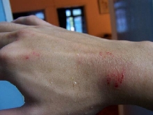 ornata bite