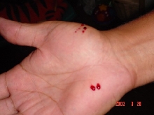 bitten2