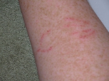 Rat Bite