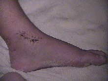 Ankle #2