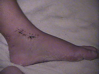 Ankle #2