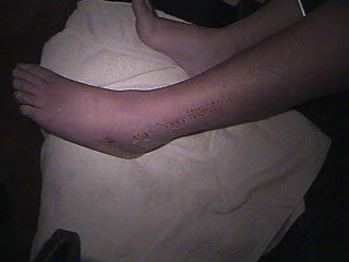 Ankle #1