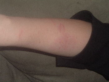 Malagasy Blonde Hognose Bite