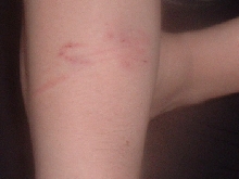 Malagasy Blonde Hognose Bite