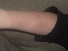 Malagasy Blonde Hognose Bite