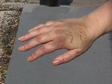 Snake Bite