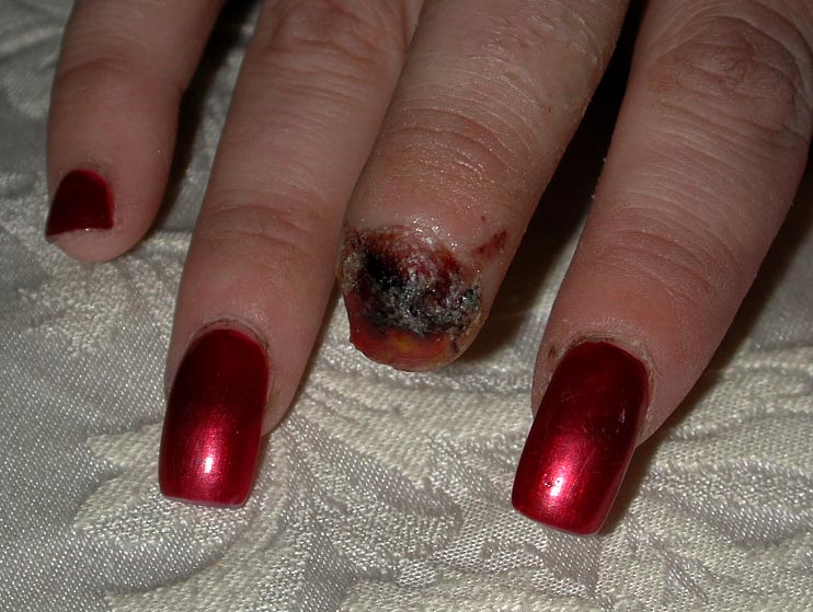 Tiger bite
