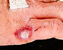 African sac spider bite 1.