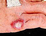 African sac spider bite 1.