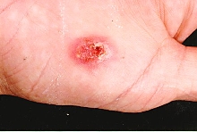 African sac spider bite 2.