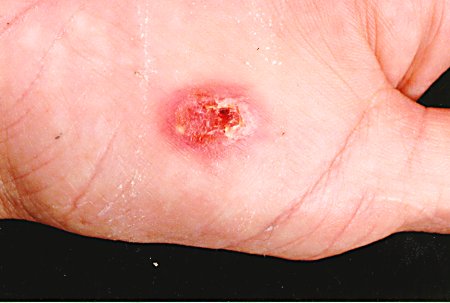 African sac spider bite 2.