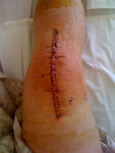 "ol" coursing injury