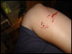 Snake bite