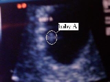 Ultrasound I'm having TWINS!! This is "Baby A"