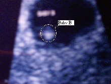 Ultrasound pic, I'm having TWINS!! This is "Baby B"