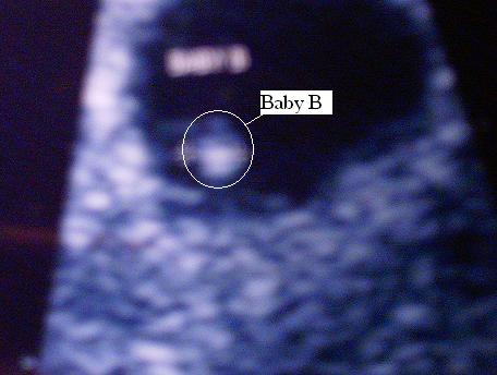 Ultrasound pic, I'm having TWINS!! This is "Baby B"