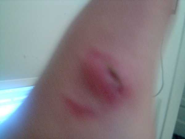 Another of kai's bite