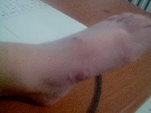 Kai's Iguana Bite